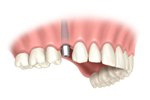 Single Tooth Replacement Installation in Medford, OR